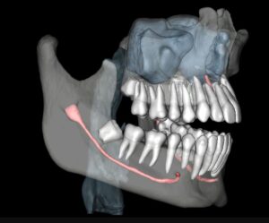 Why is a Cone Beam CT Scan important in wisdom teeth removal?